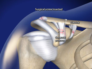 Arthroscopic Acromioclavicular (AC) Joint Separation Repair in Plano,  Frisco, McKinney and Allen