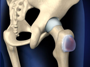 Different Bursitis Hip Treatments
