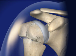 proxhumerusfracture 300 - Złamanie nasady bliższej kości ramiennej- jak powinna wyglądać rehabiltiacja?
