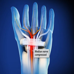 Treating Carpal tunnel syndrome in Plano, Frisco, McKinney and Allen