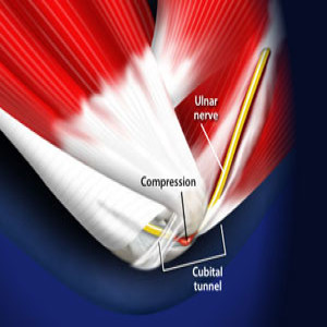 Treating Cubital Tunnel Syndrome in Plano, Frisco, McKinney and Allen