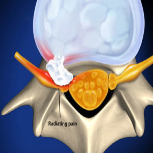 Treating Coccydynia or tailbone pain in Plano, Frisco, McKinney and Allen