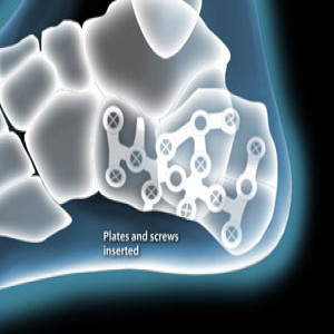 Calcaneal Fracture Fixation in Plano, Frisco, McKinney and Allen