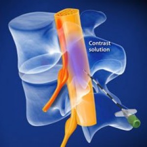 Lumbar Epidural Steroid Injection in Plano, Frisco, McKinney and Allen