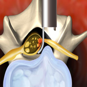 Micro endoscopic discectomy in Plano, Frisco, McKinney and Allen