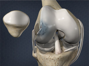 Treating Osteochondritis Dissecans of the Knee in Plano, Frisco, McKinney and Allen