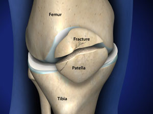 Treating Patella Fracture (Broken Knee Cap) in Plano, Frisco, McKinney and Allen