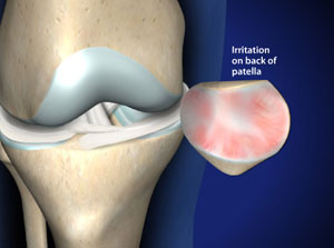 Treating Patellofemoral Pain Syndrome (Runners Knee) in Plano, Frisco, McKinney and Allen