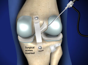 Posterior Cruciate Ligament (PCL) Reconstruction in Plano, Frisco, McKinney and Allen