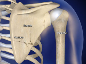 Treating Shoulder Blade (Scapula) Fractures in Plano, Frisco, McKinney and Allen