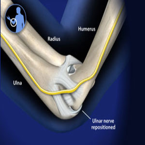 Treating Ulnar nerve transposition in Plano, Frisco, McKinney and Allen