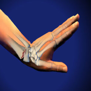 Treating colles fractures in Plano, Frisco, McKinney and Allen