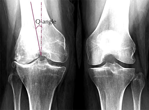 joint replacement, now what?