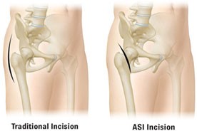 minimally invasive hip replacement surgery