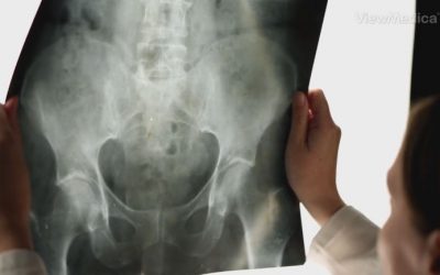 What Type of Therapy Is Needed After Labral Tear Surgery?