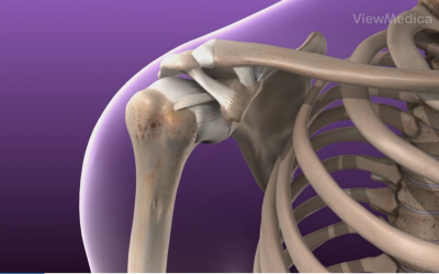 What is Instability of the Shoulder?
